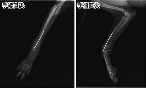 手術直後の橈尺骨骨折のレントゲン画像