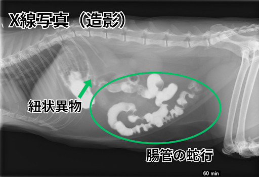 バリウム造影された紐状異物のX線画像