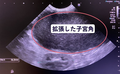 エコーで確認された拡張した子宮角