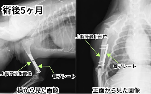 術後5ヶ月の上腕骨骨折のレントゲン画像