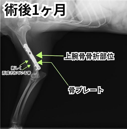 術後1ヶ月の上腕骨骨折のレントゲン画像