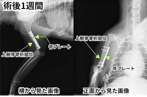 術後1週間の上腕骨骨折のレントゲン画像