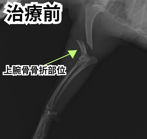 治療前の上腕骨骨折のレントゲン画像