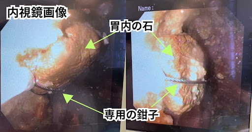 内視鏡で見た時の胃の中の石