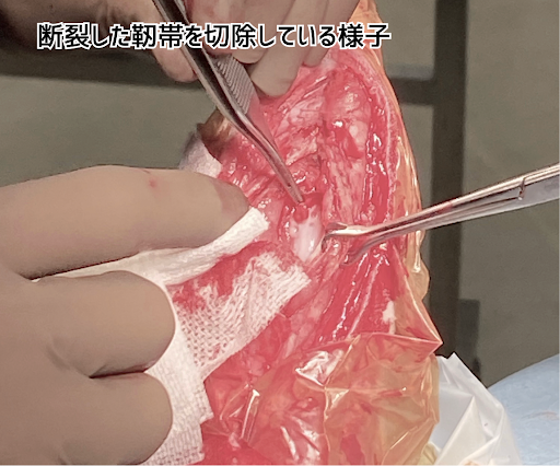 断裂した靭帯を切除している様子