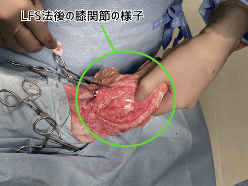 LFS法後の膝関節の様子