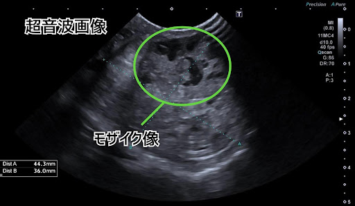精巣腫瘍のエコー検査画像