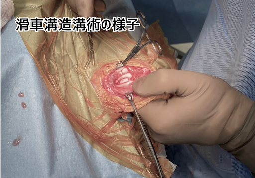 滑車溝造溝術の様子