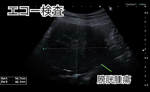 膀胱腫瘍のエコー検査