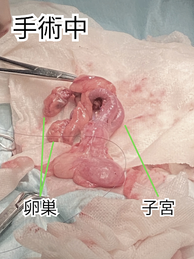 子宮と卵巣を摘出しようとしている状態