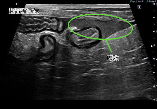 超音波検査で腹水が溜まっている様子