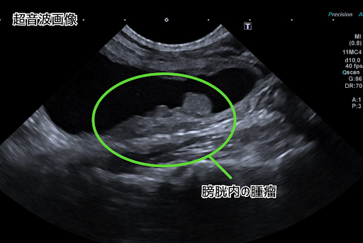 膀胱内の腫瘤