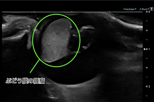 ぶどう膜の腫瘤のエコー画像