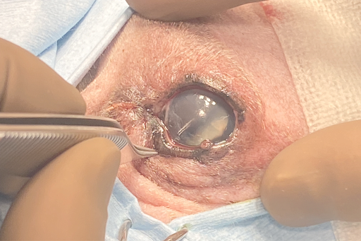 眼球摘出の手術の画像