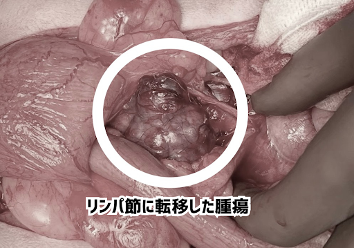 リンパ節に転移した腫瘍の画像