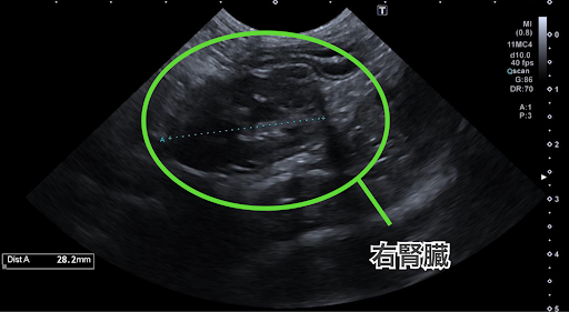 右の腎臓のエコー画像