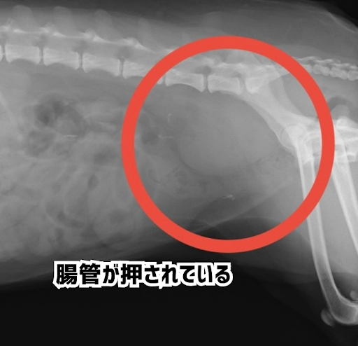 リンパ節転移によって押されている腸管のレントゲン画像