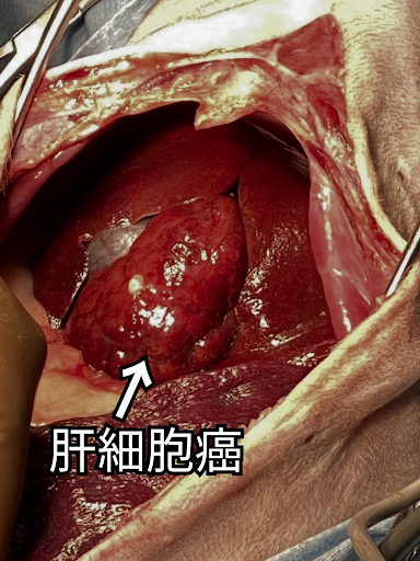 肝細胞癌の様子