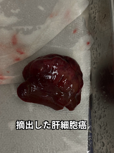 摘出した肝細胞癌