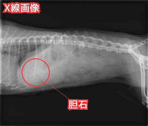 胆石のX線画像