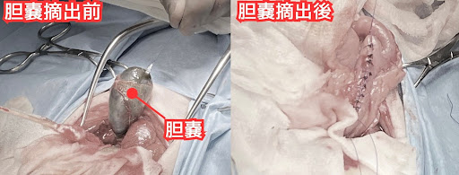 胆嚢摘出前、胆嚢摘出後の画像