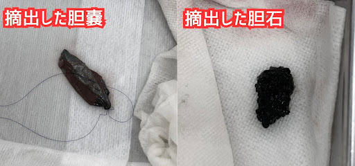 摘出した胆嚢と胆石