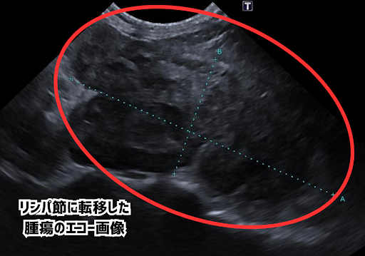リンパ節転移した腫瘍のエコー画像