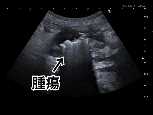 エコーでの腫瘍の様子
