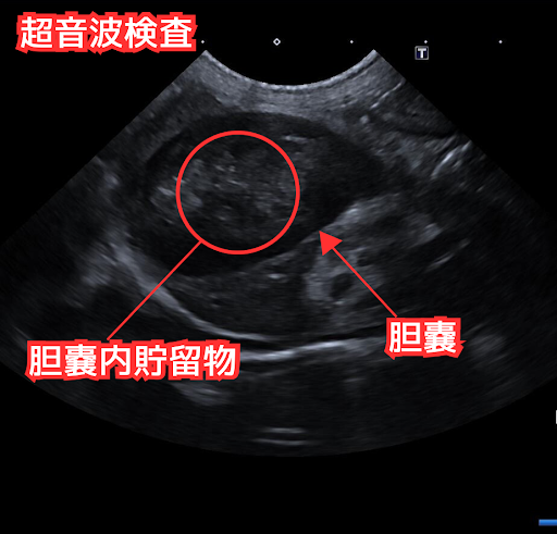 胆石の超音波検査画像