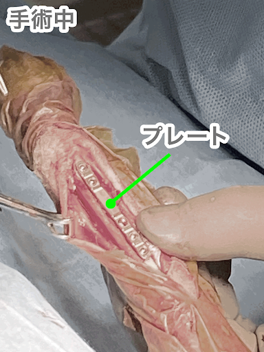 骨折に対してプレートを入れている様子