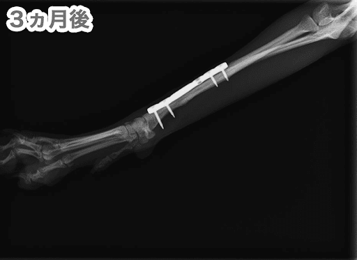 3ヶ月後の骨折の様子