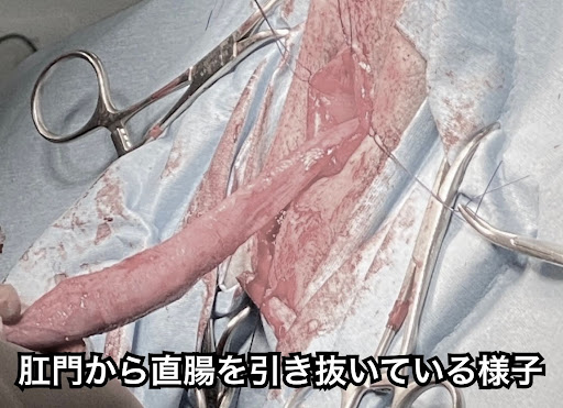 肛門から直腸を引き抜いている様子