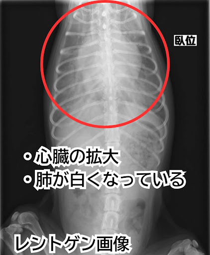 治療前の肺水腫のレントゲン画像