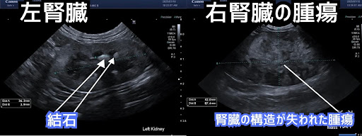 腎細胞癌のエコー画像