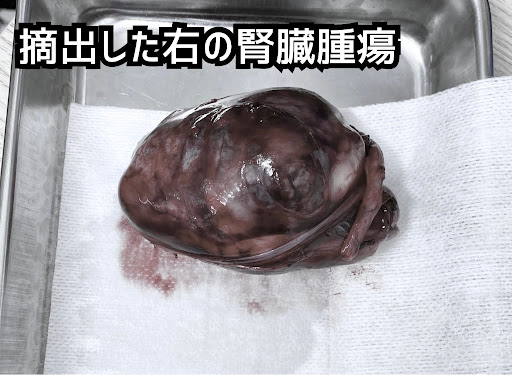 摘出した右の腎臓腫瘍