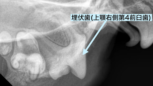 上顎右側の埋伏歯