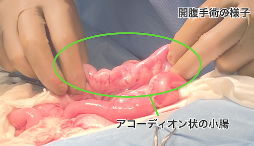 アコーディオン状の腸の状態