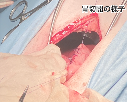 胃切開の様子