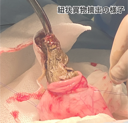 紐状異物を摘出している様子
