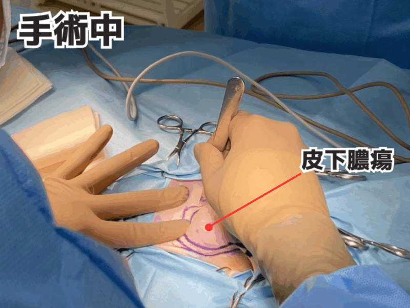 皮下膿瘍の手術中の画像