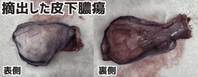 摘出した皮下膿瘍