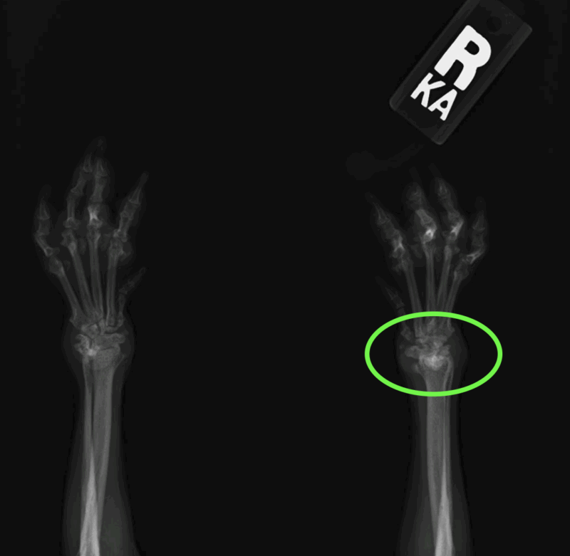 関節リウマチのレントゲン画像