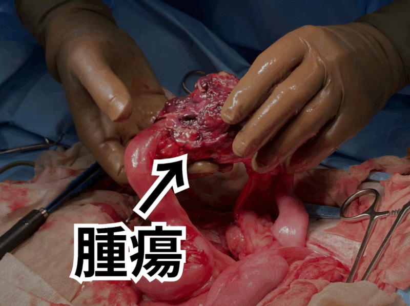 腫瘍を摘出する様子