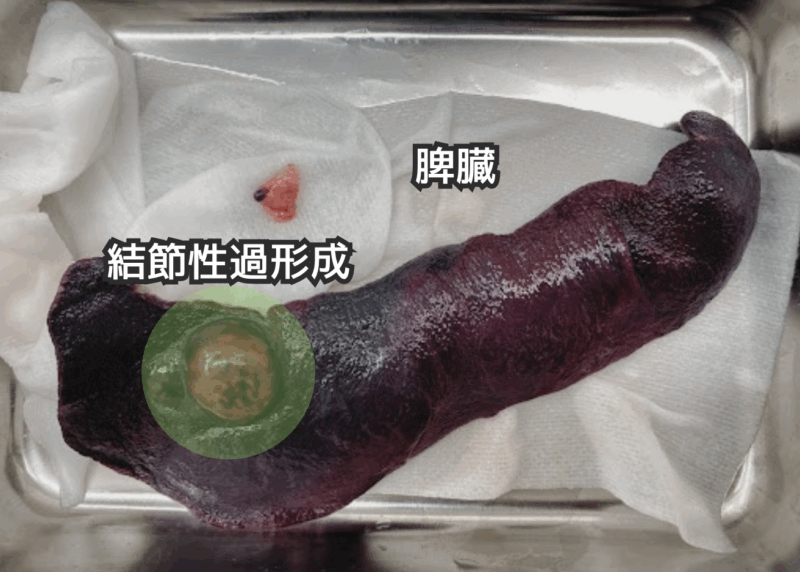 結節性過形成の脾臓