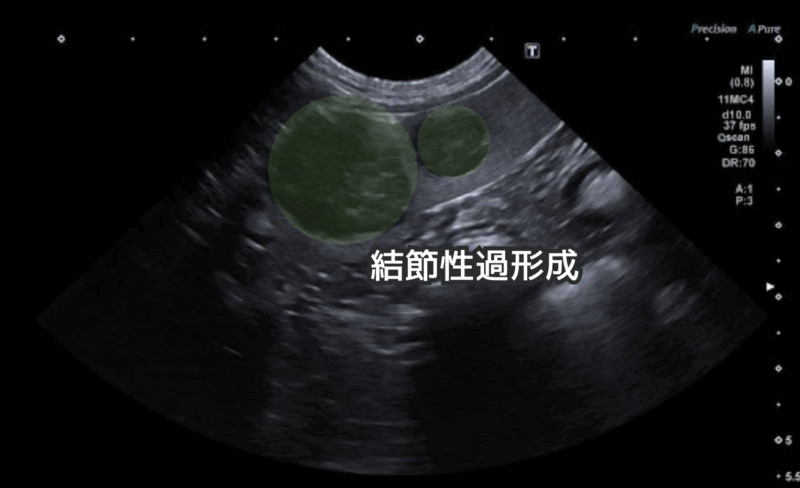 脾臓の結節性過形成のエコー画像